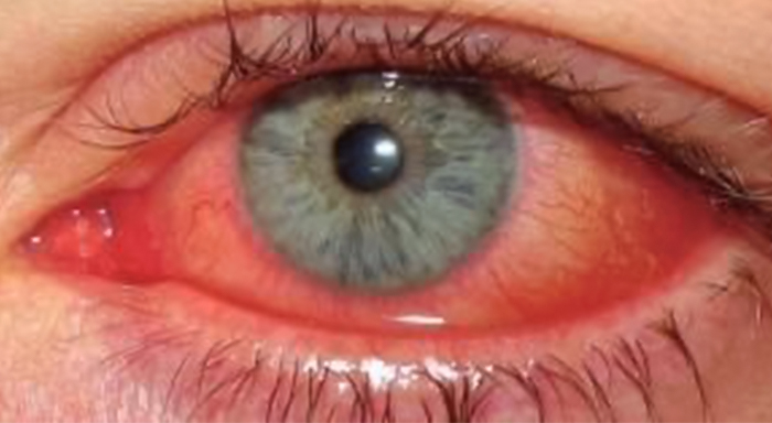 Ojo inflamado con conjuntivitis alérgica
