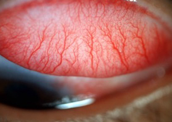 conjuntiva palpebral normal