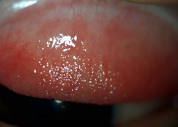 conjuntiva conjuntivitis alérgica estacional