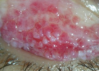 Ojo con queratoconjuntuvitis primaveral