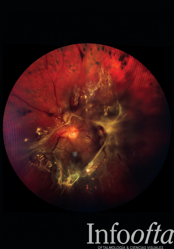 Desprendimiento de retina, procedimiento de oftalmología, fotografía clínica
