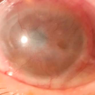 vascularización corneal posterior a trasplante de córnea con factor de riesgo crítico