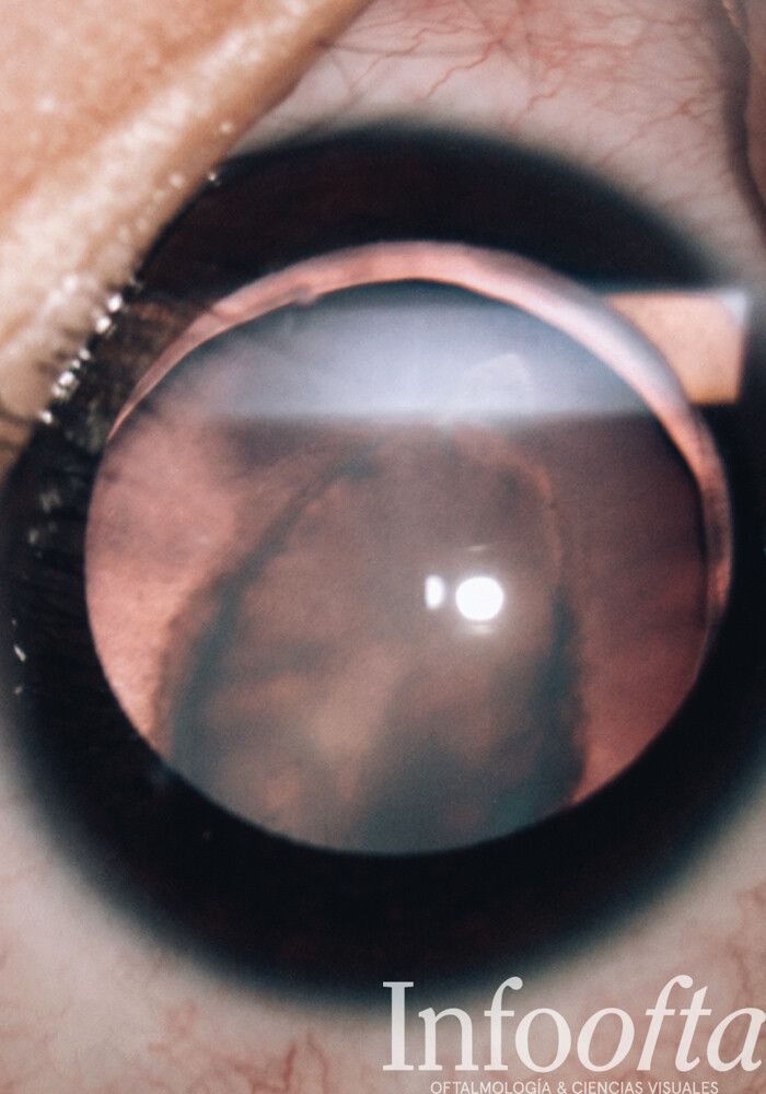 lenticono posterior, afección ocular, fotografía clínica