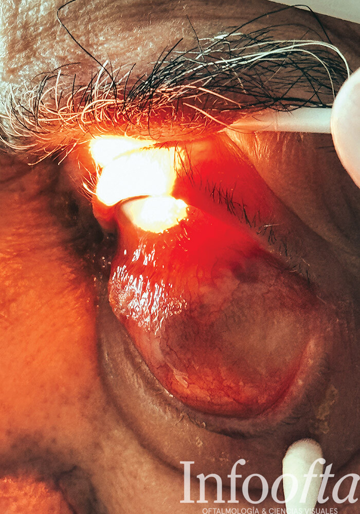 tumor de colisión, padecimiento ocular, fotografía clínica