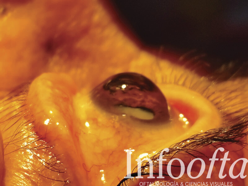ectasia corneal, fotografía clínica de padecimientos oculares