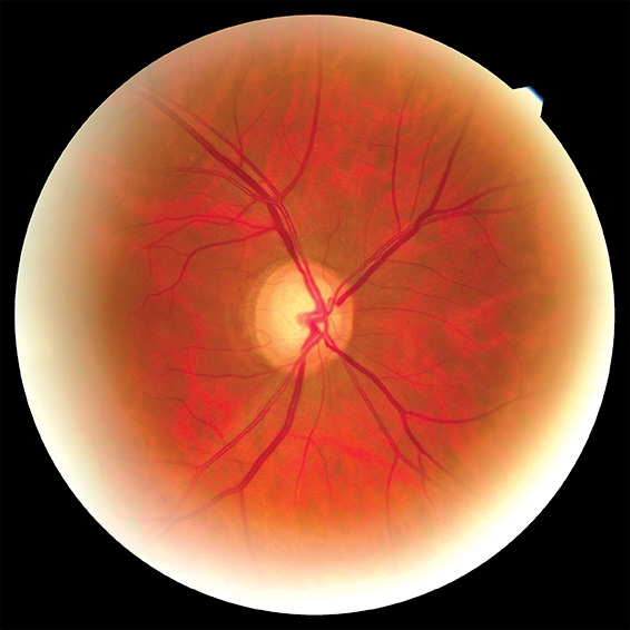Fotografía médica de globo ocular con glaucoma