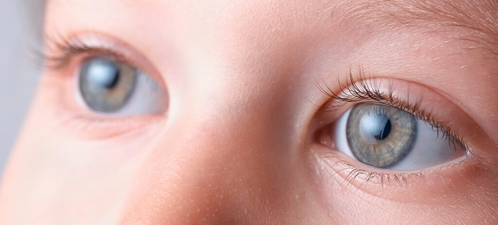 Ojos de un niño, estudio sobre epidemiología de glaucoma primario congénito