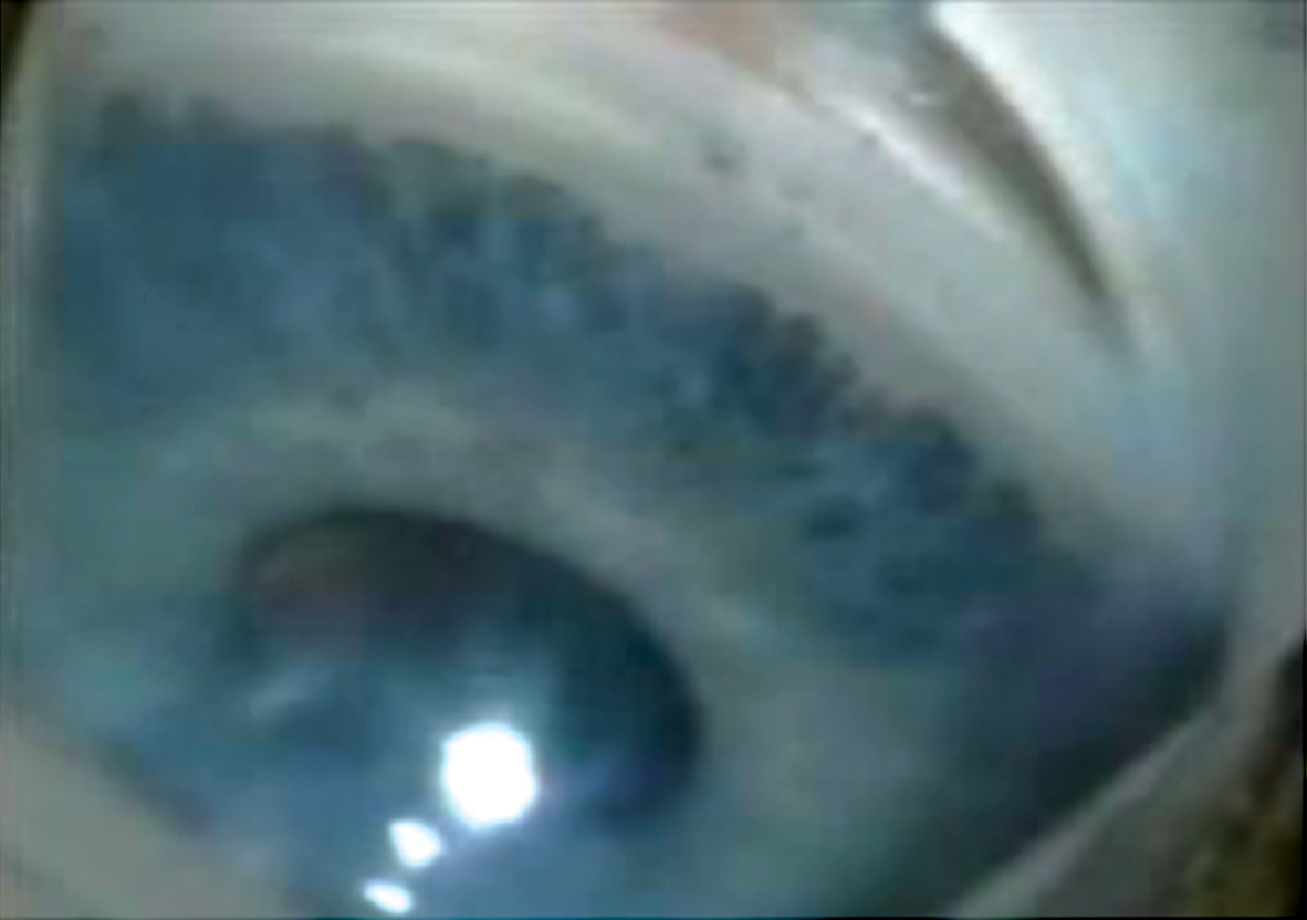 inserción elevada anterior del iris