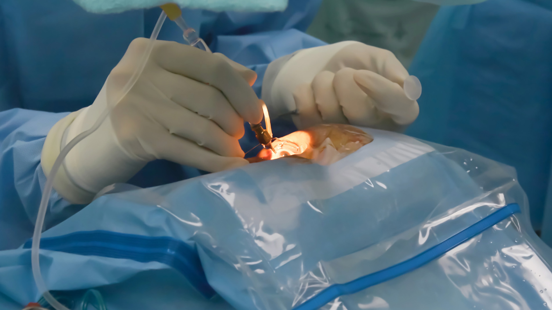 oftalmólogo cirujano realizando operación en ojo con miopía