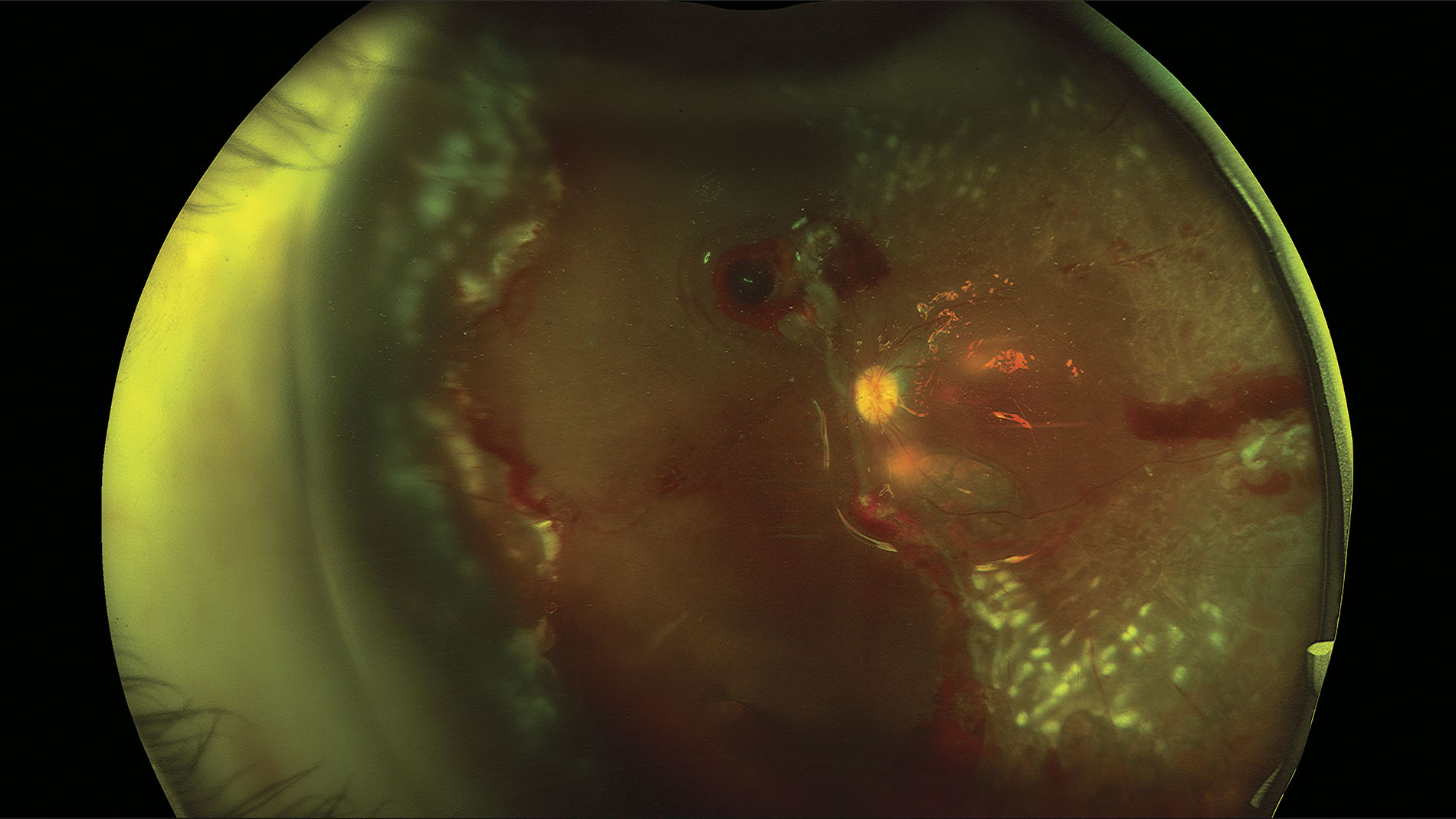 Desprendimiento de retina examen médico oftalmología