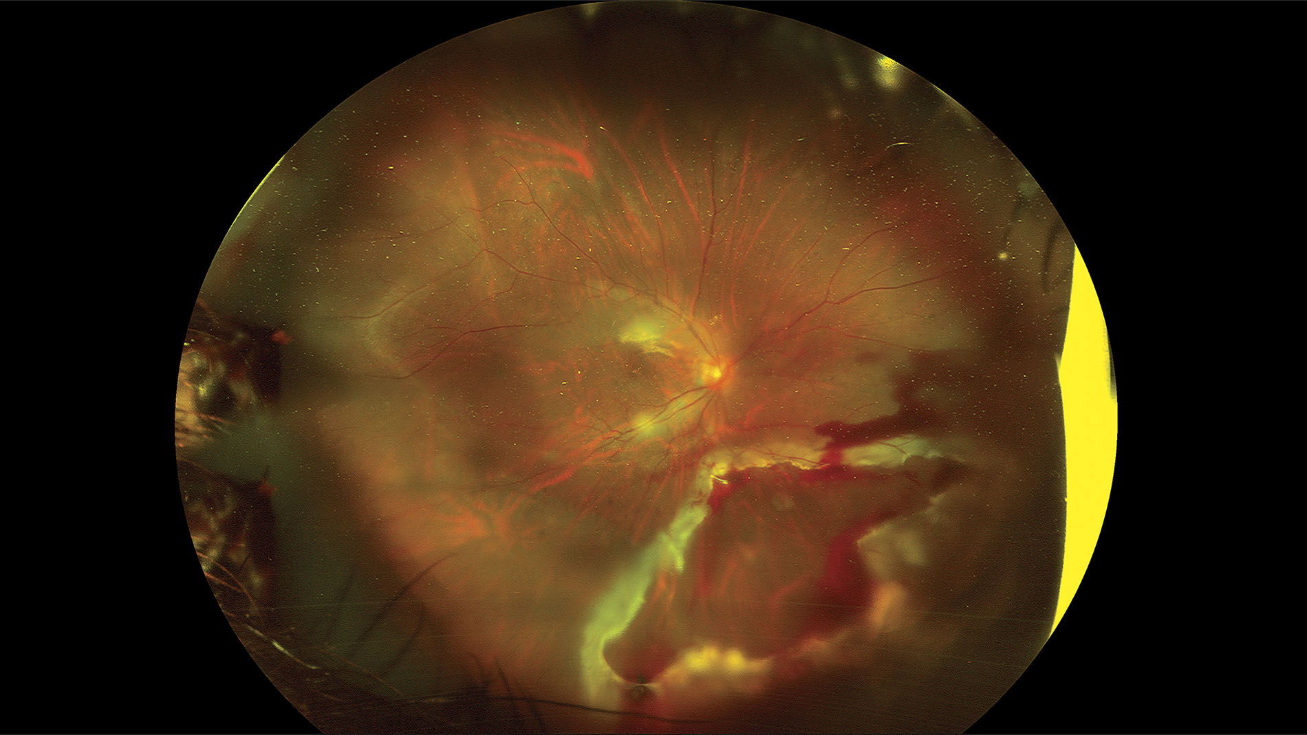 resultado de manejo de desprendimiento de retina cirugía