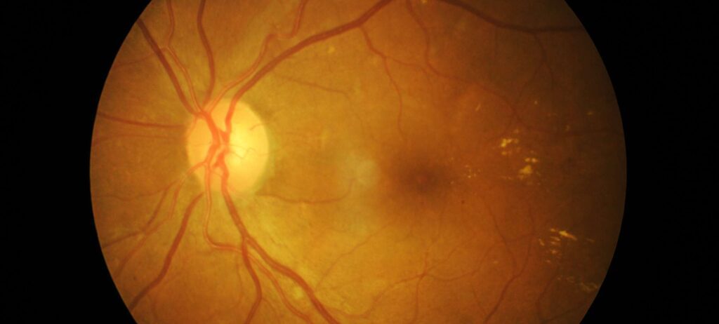 Desprendimiento de retina corregida con retinectomía