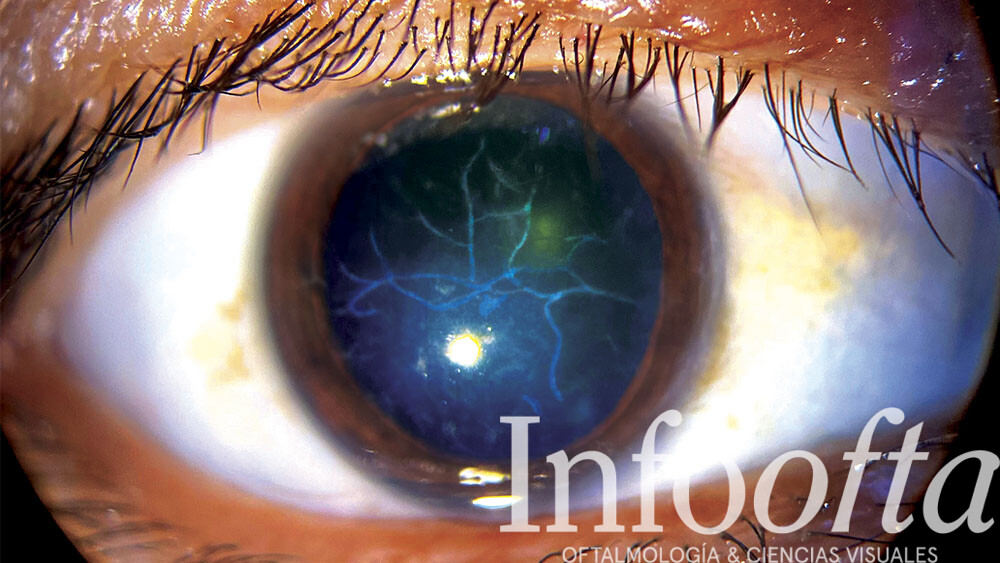 Paciente con distrofia corneal en lattice, daño ocular, afección de los ojos