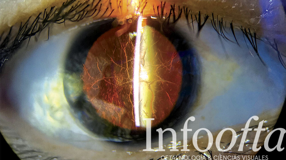 distrofia corneal, imagen clínica con técnica de retroiluminación