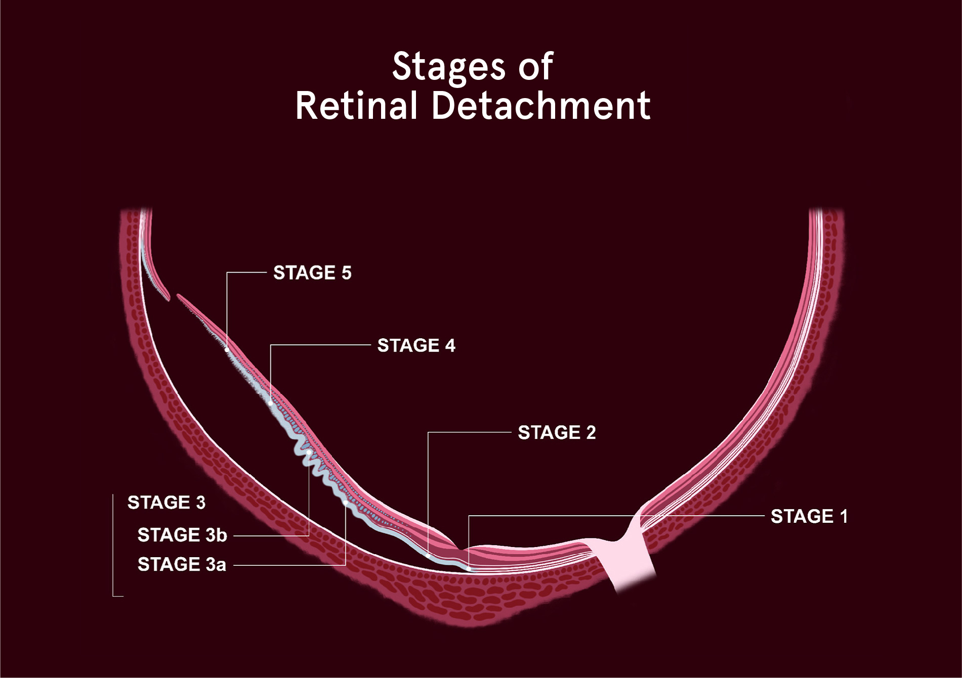 Gráfico que muestra las etapas del desprendimiento de retina