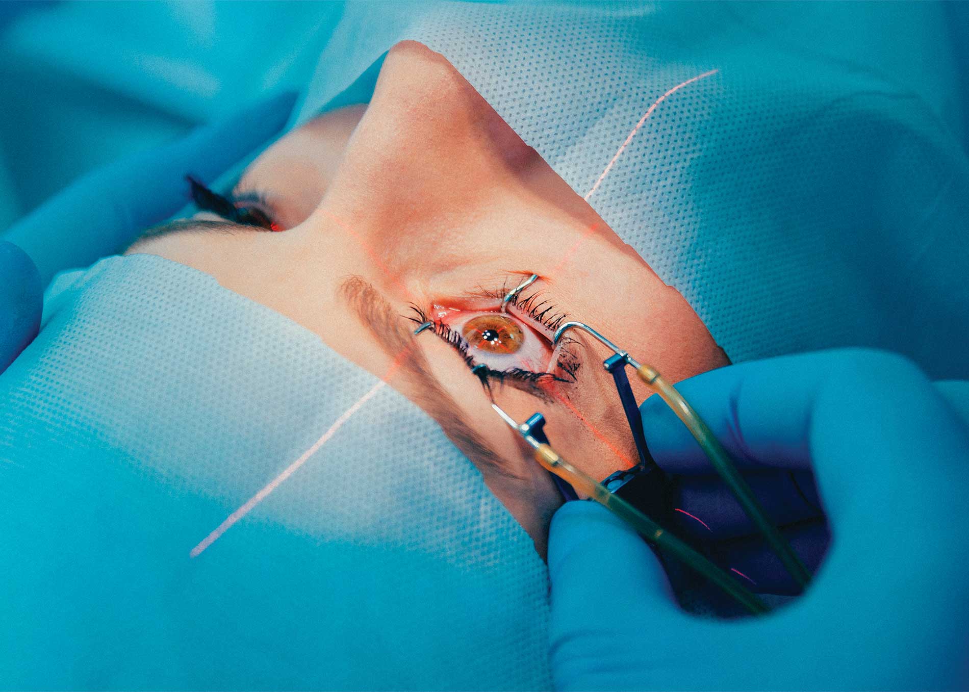 Fotografía en primer plano de una mujer recibiendo cirugía de laser en el ojo izquierdo. Se observa la mano de un médico cirujano sosteniendo equipo médico de oftalmología