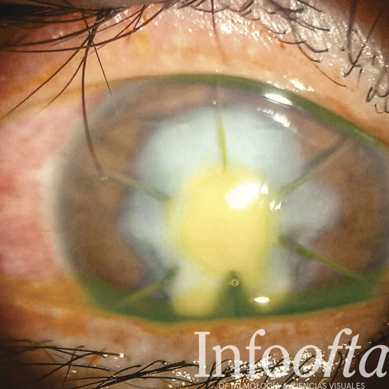 Fotografía de un ojo enfermo con queratitis fúngica