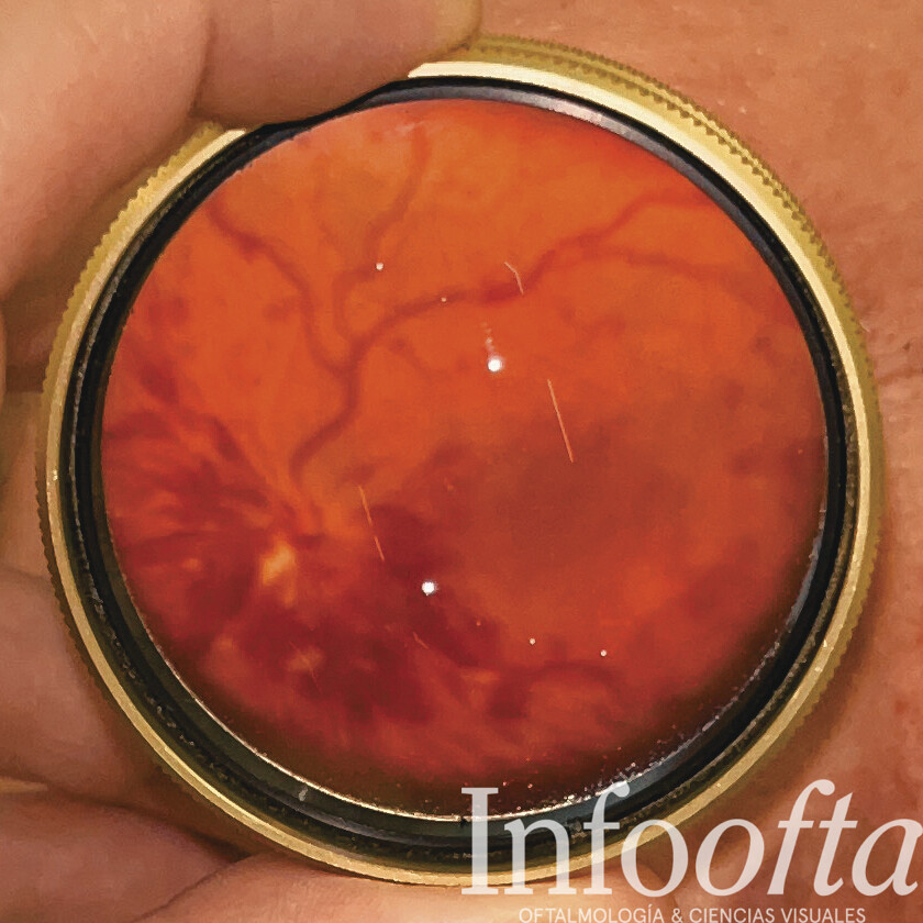 obstrucción vena central de la retina