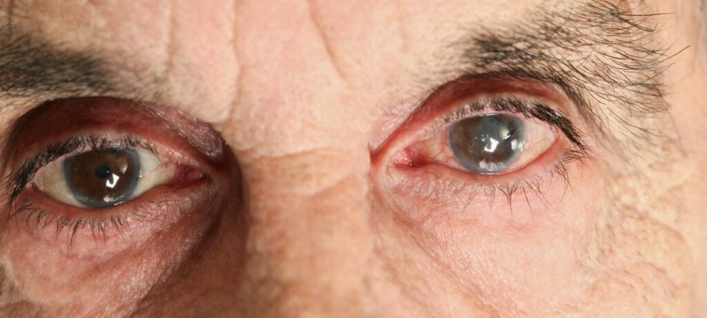 adulto mayor con enfermedad en los ojos glaucoma o cataratas
