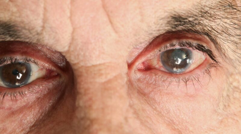 adulto mayor con enfermedad en los ojos glaucoma o cataratas