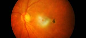 acercamiento de un globo ocular durante estudio de retina donde se observan algunas venas
