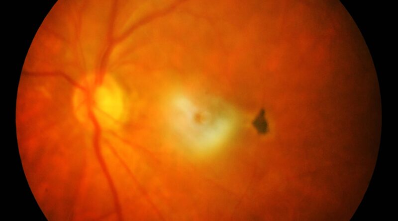 acercamiento de un globo ocular durante estudio de retina donde se observan algunas venas