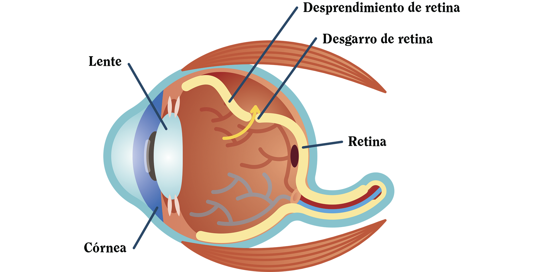 Diagrama de un ojo donde se muestra el desprendimiento de retina, desgarre de retina entre otras cosas.