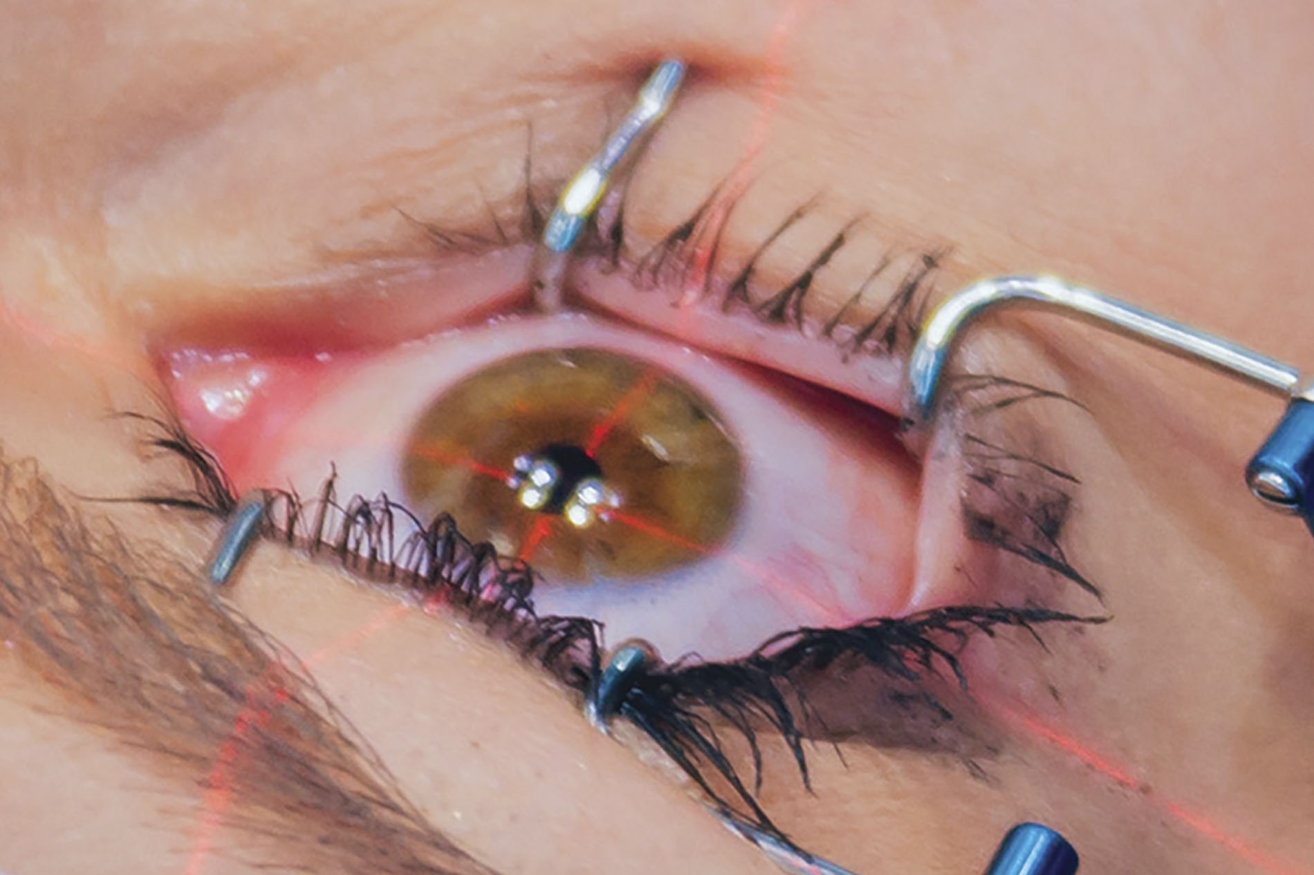 Laser rojo sobre ojo humano en cirugía