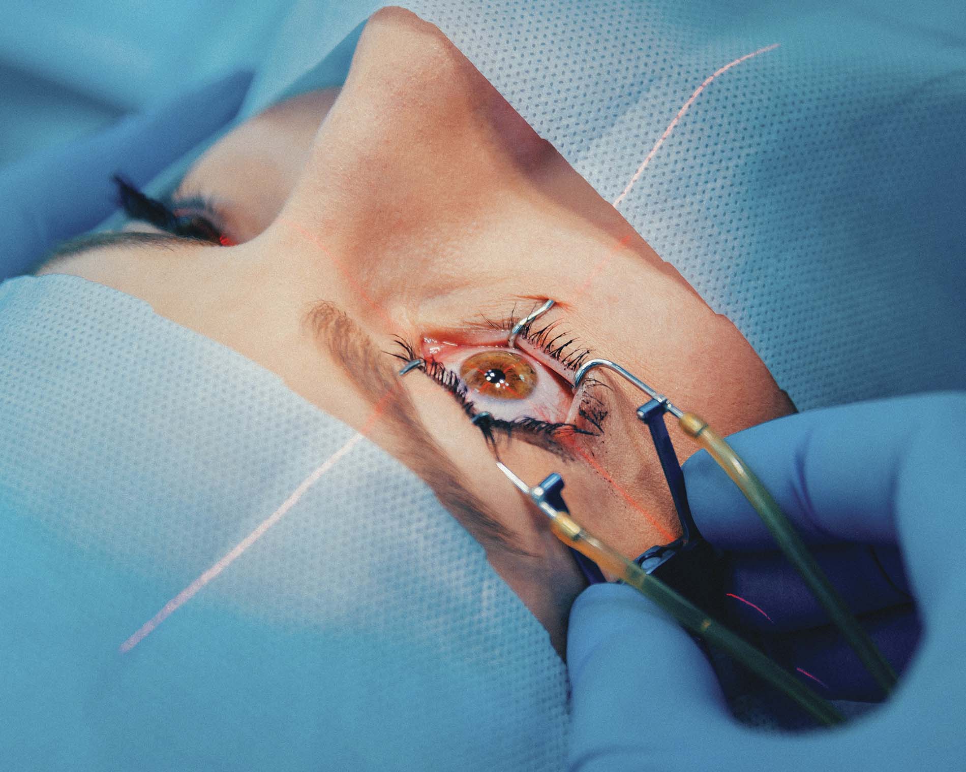 Ojo de mujer recibiendo cirugía de láser para corrección de la vista