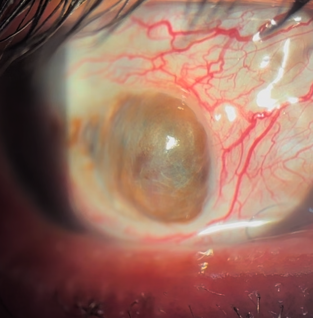 Ojo con lisis colgajo conjuntival, mostrado en imagen clínica oftalmológica