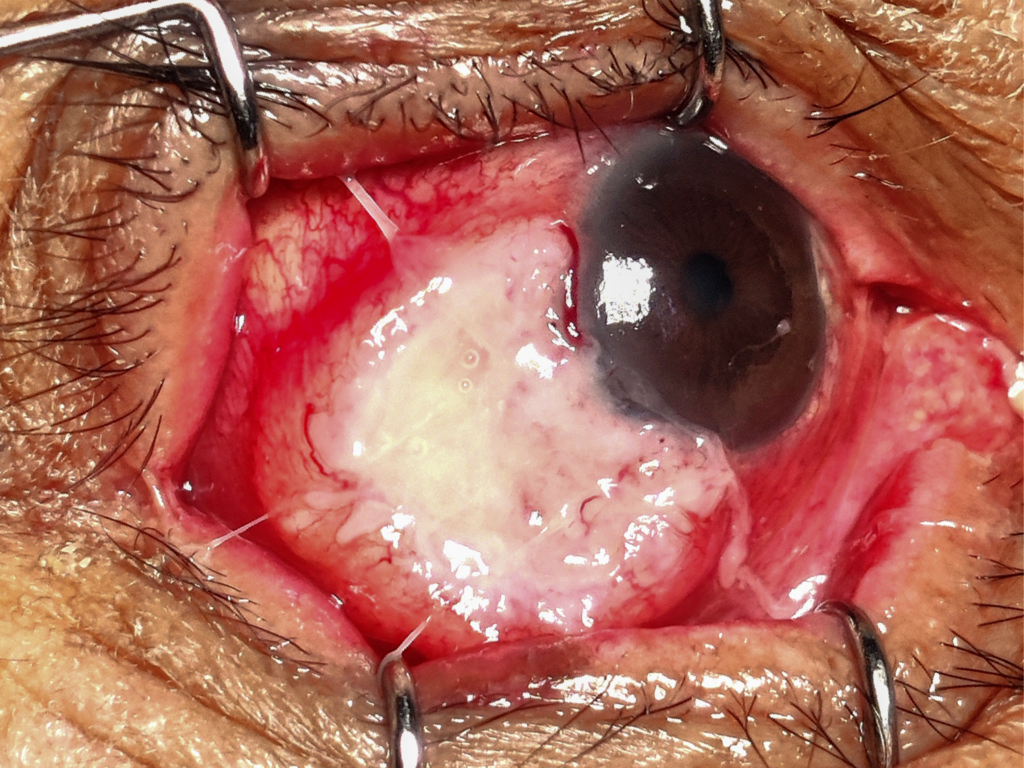 Fotografía clínica oftalmológica, mostrando ojo con afectación ocular neoplasia escamosa de la superficie ocular