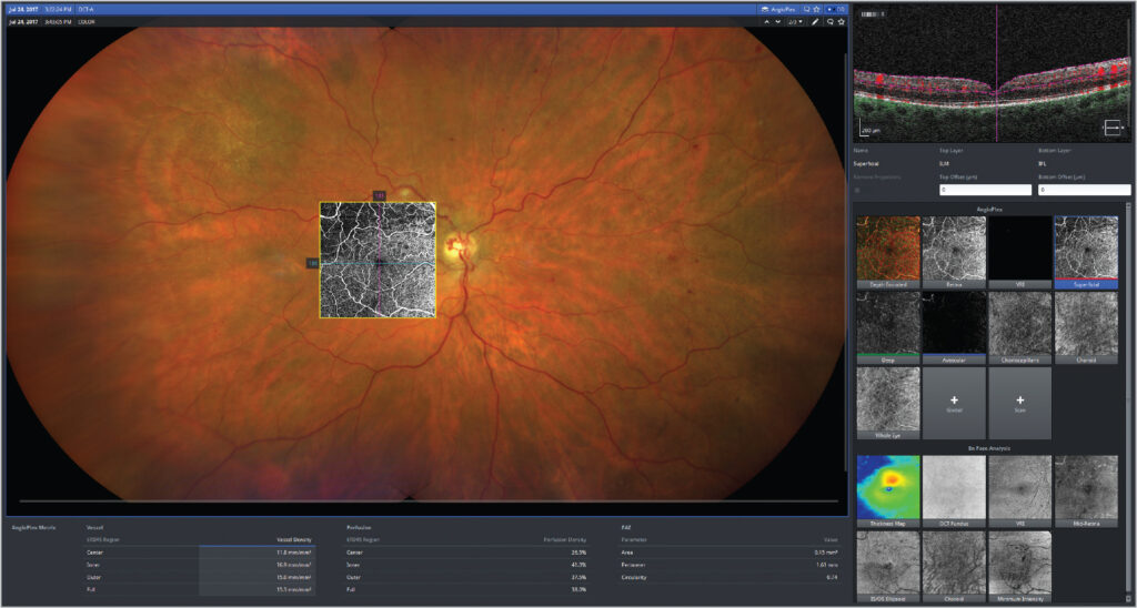 Captura de pantalla de un estudio OCT-A que muestra una imagen de retina a color con superposición de un mapa de flujo vascular en escala de grises, junto con análisis detallado de capas retinianas, métricas de perfusión y densidad vascular.