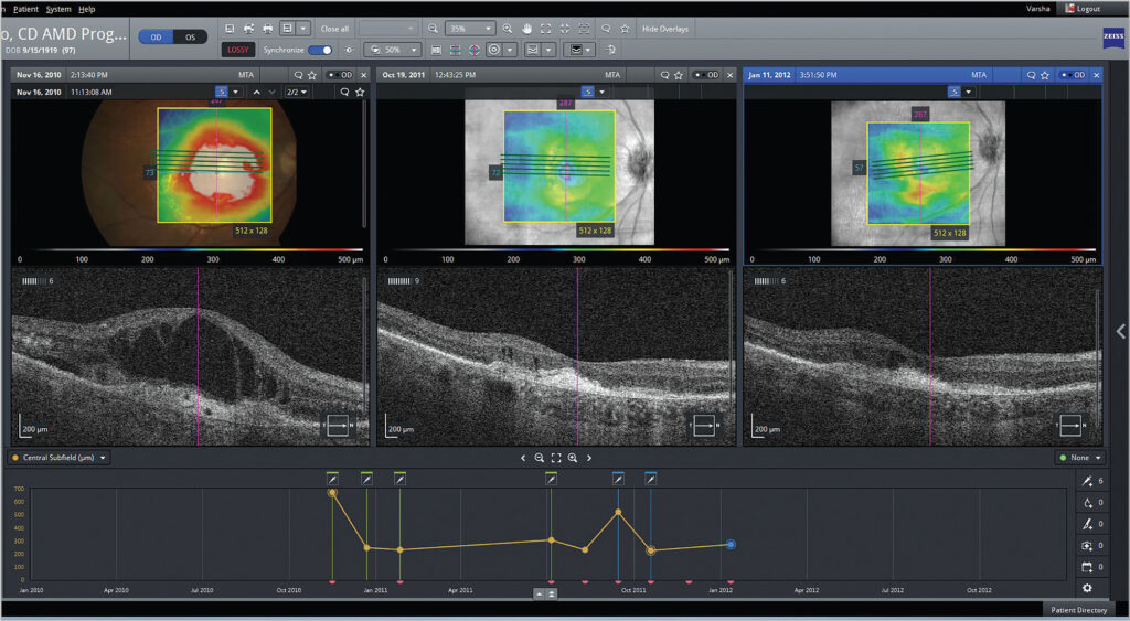 Pantalla dividida en tres secciones que compara escaneos maculares de un paciente en diferentes fechas mediante imágenes OCT y mapas de grosor retinal, acompañadas de gráficas de evolución clínica en el tiempo.