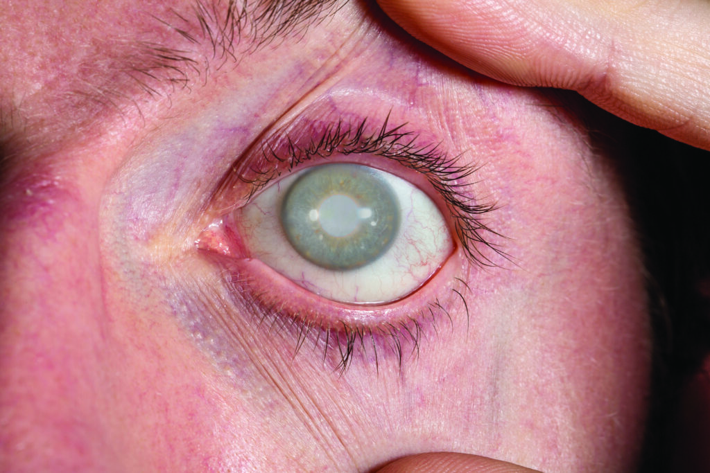 Primer plano de un ojo humano afectado por glaucoma, mostrando opacidad en el cristalino y signos visibles en la pupila. Ejemplo de cómo las tecnologías de imagen y modelos predictivos pueden detectar glaucoma en fases iniciales.