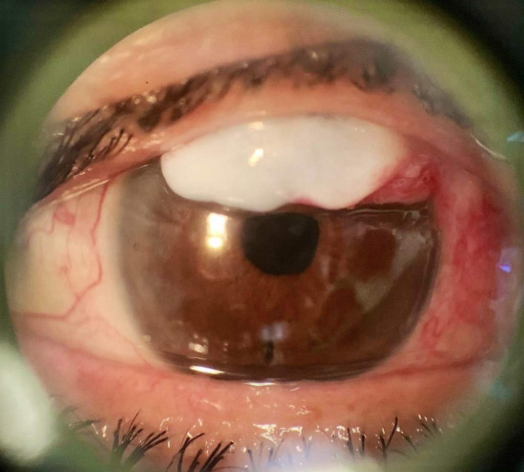 Caso médico en estudio LiGHT, fotografía de ampolla filtrante avascular en un ojo