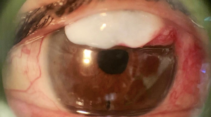 Caso médico en estudio LiGHT, fotografía de ampolla filtrante avascular en un ojo
