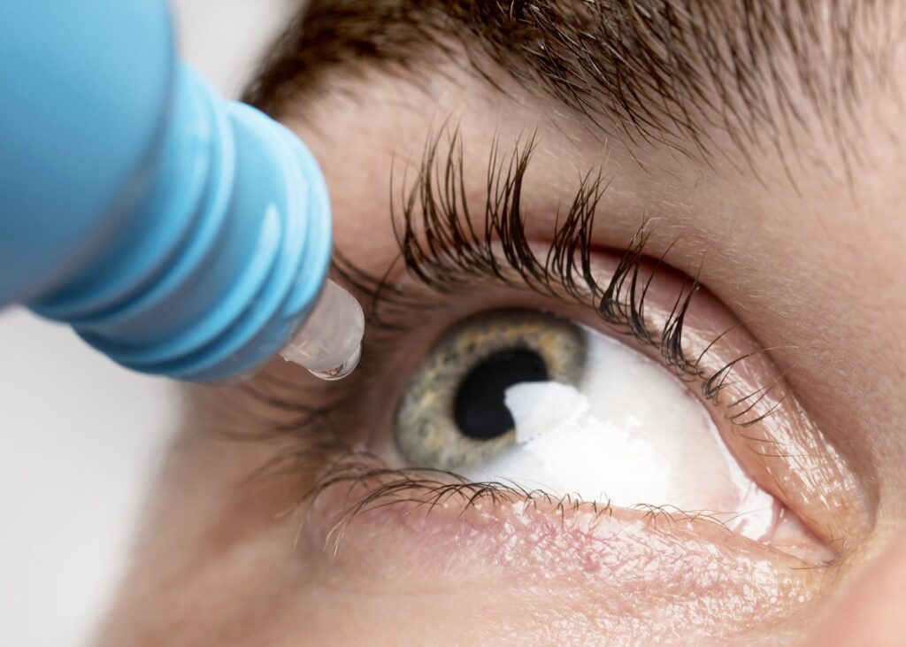Gota oftálmica aplicándose en un ojo abierto con la mirada hacia arriba. Esta imagen representa tratamientos comunes para el ojo seco, una condición evaluada con ayuda de apps móviles y datos clínicos automatizados.