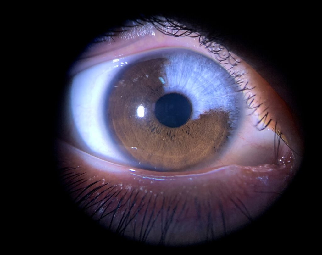 Ojo con heterocromía de iris, ojos color café y azul