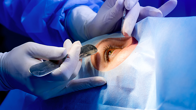 Imagen donde se realiza cirugía de glaucoma a persona adulta.