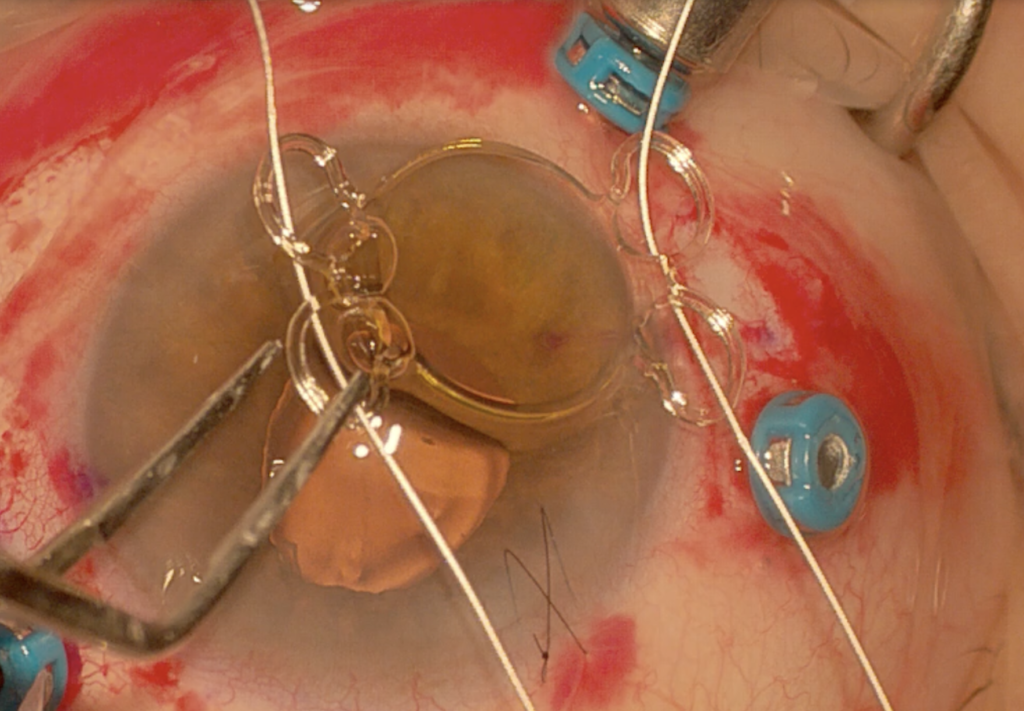 Lente intraocular con 4 puntos de fijación para sutura a esclera con GORE-TEX.