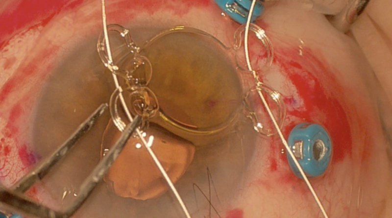 Lente intraocular con 4 puntos de fijación para sutura a esclera con GORE-TEX.