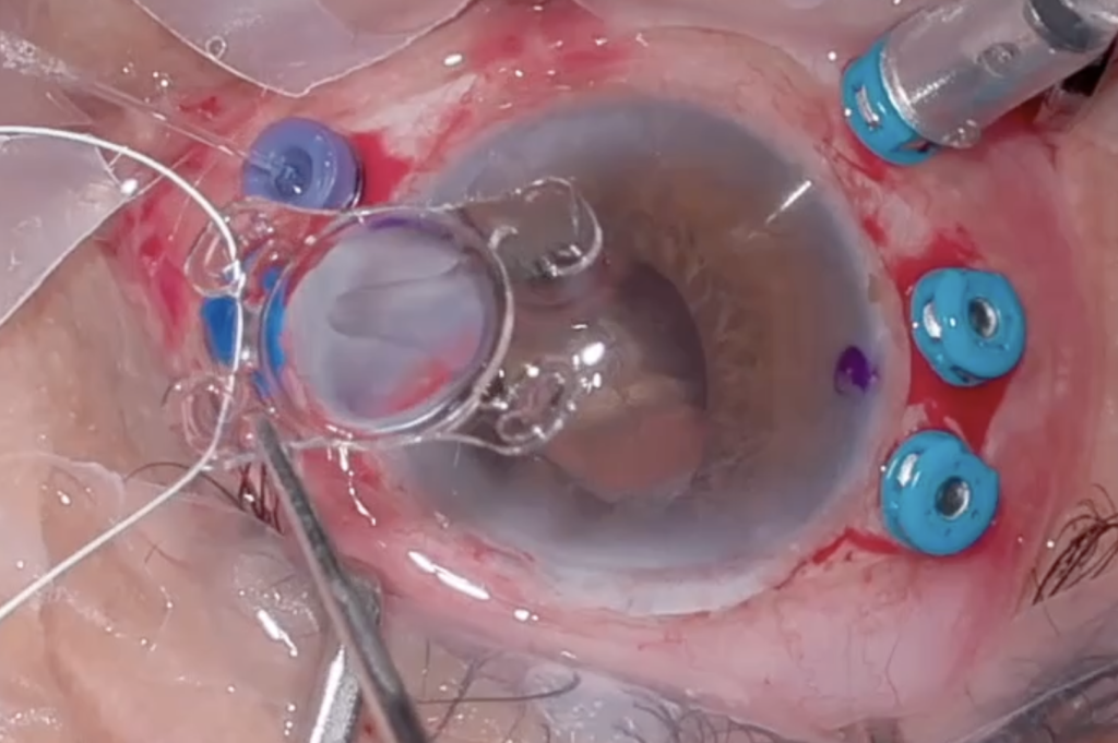 Lente Akreos con 4 hápticas, usando sutura GORE-TEX para fijación escleral de 4 puntos.