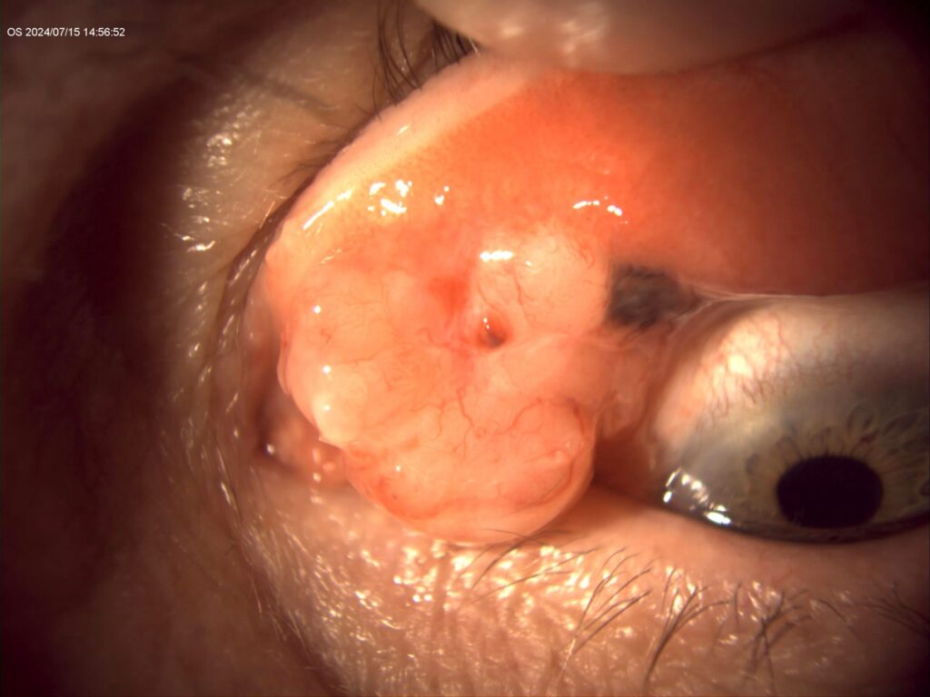 El enemigo de la superficie ocular: melanoma de conjuntiva