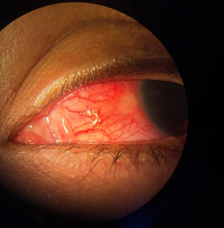 Fotografía clínica del mes_Vol.11_Escleritis nodular anterior