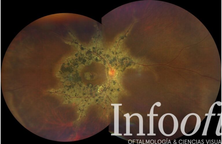 Fotografía clínica del mes_Vol.11_Atrofia coriorretiniana pigmentada paravenosa