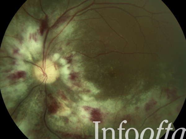 Retinitis por CMV – “Fields of Fire”