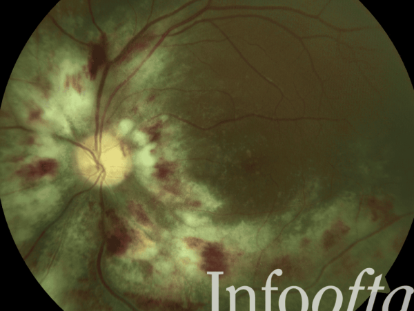 Retinitis por CMV – “Fields of Fire”