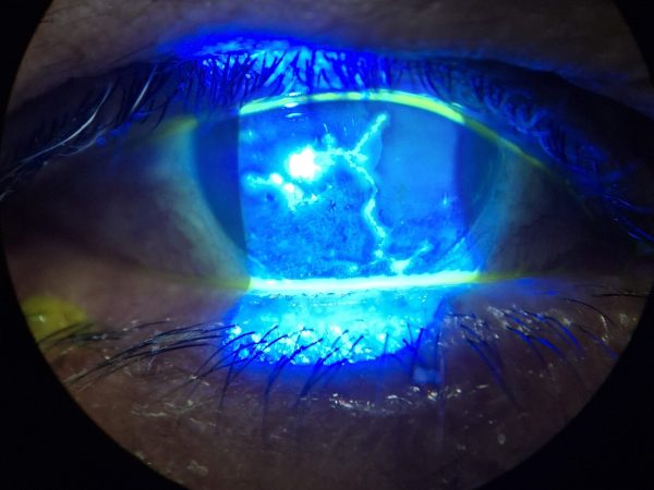 enfermedad clínica, fotografía de herpes ocular para su estudio