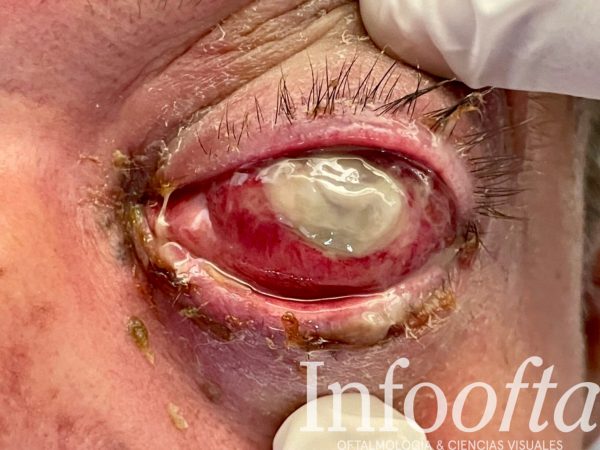 Cuando el ojo grita: imagen cruda de endoftalmitis