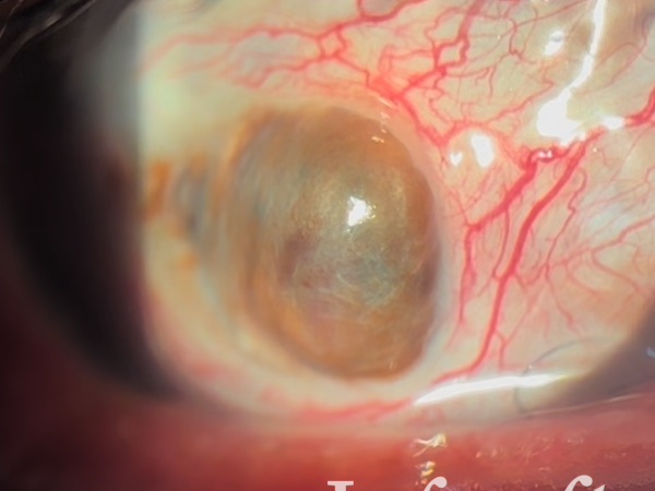 Ojo con lisis colgajo conjuntival, mostrado en imagen clínica oftalmológica